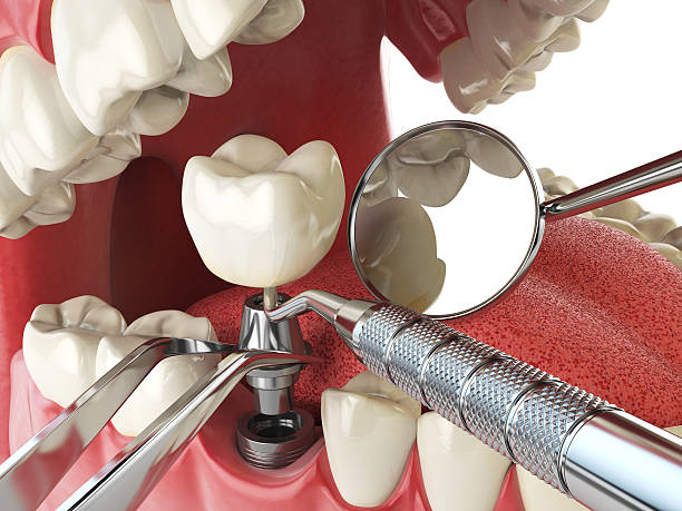 Best Emergency Tooth Extraction in Dallas Center, IA